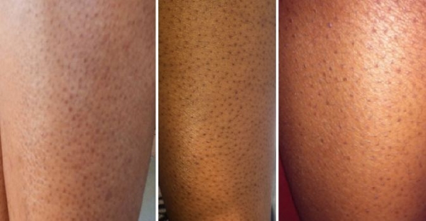 LOẠI BỎ TÌNH TRẠNG LÔNG MỌC NGƯỢC, DÀY SỪNG, CHÂN DÂU