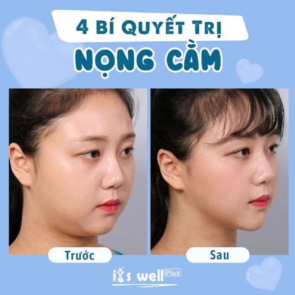 4 BÍ QUYẾT TRỊ NỌNG CẰM HIỆU QUẢ 4 BÍ QUYẾT TRỊ NỌNG CẰM HIỆU QUẢ